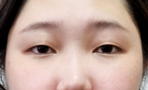 쌍꺼풀(자연유착) 후기