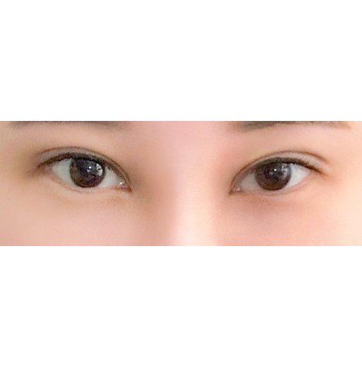 눈재수술 후기