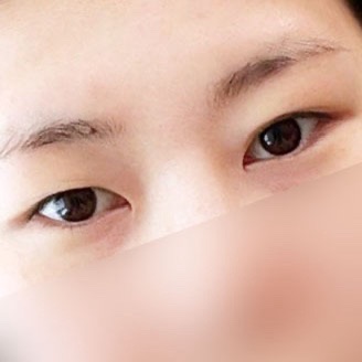 쌍꺼풀(자연유착) 후기