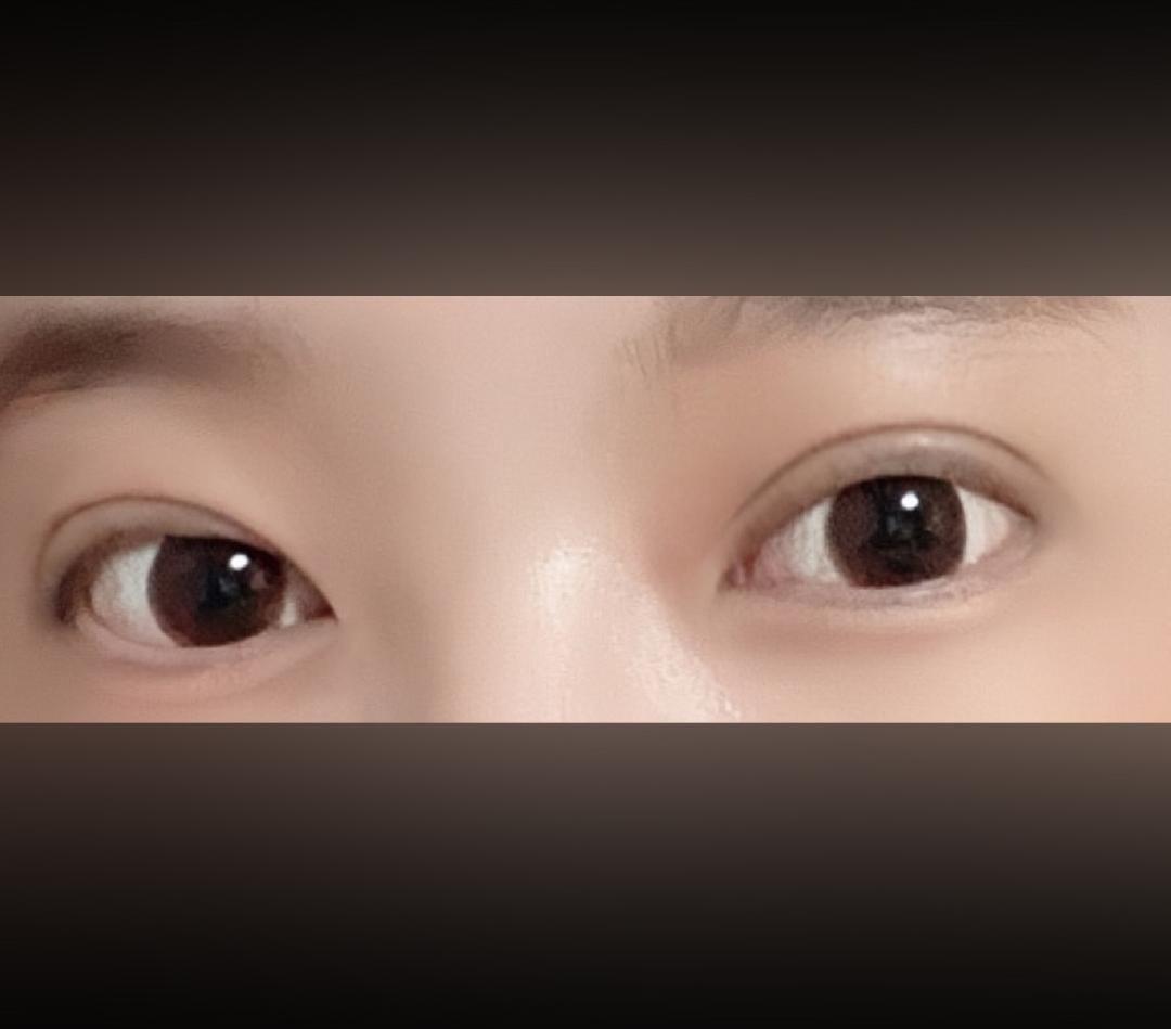 눈재수술 후기