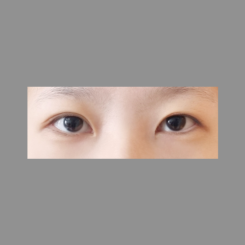 쌍꺼풀(자연유착) 후기