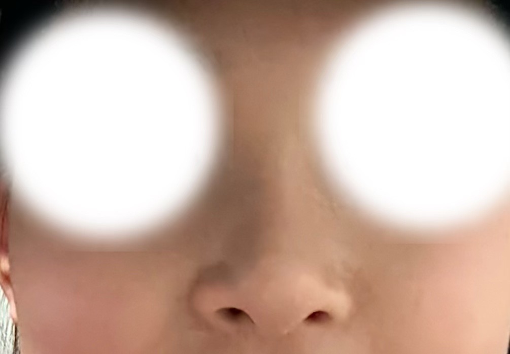 코재수술 후기