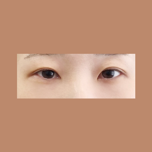 밑트임 후기