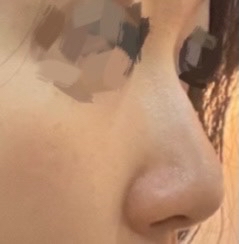 코끝(보형물) 후기
