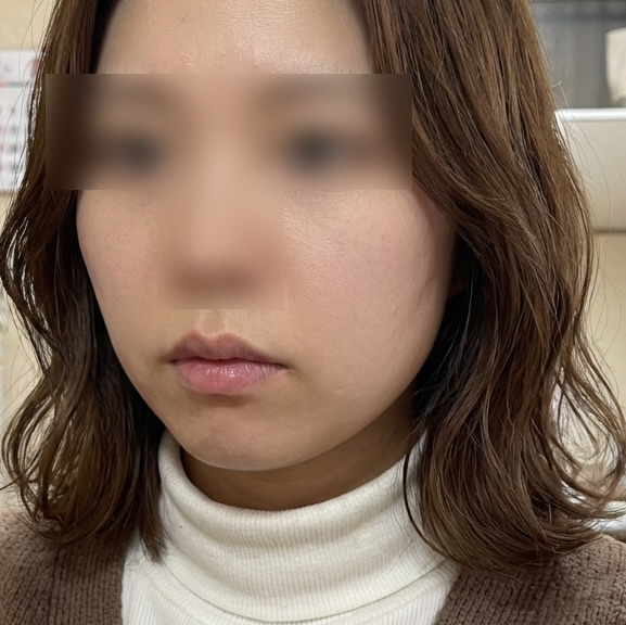 온다리프팅 후기
