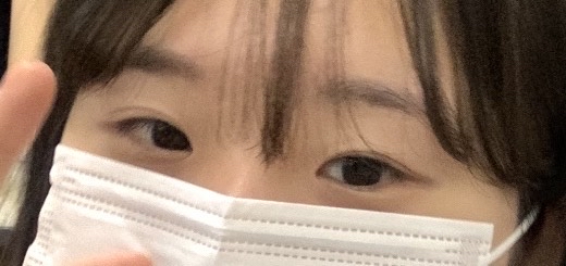 쌍꺼풀(절개) 후기