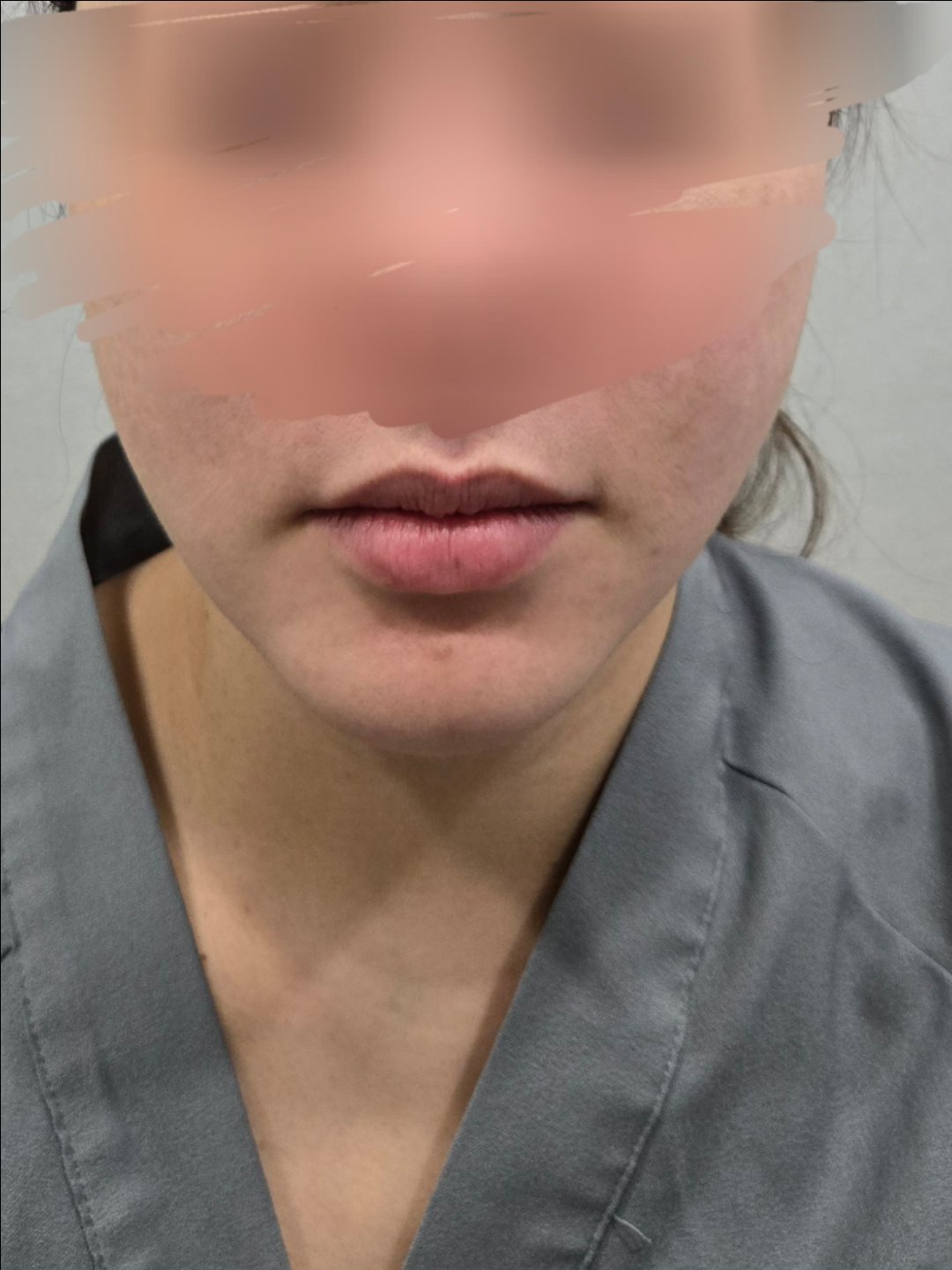 입꼬리성형 후기