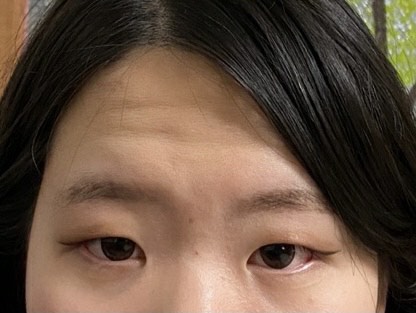 쌍꺼풀(절개) 후기