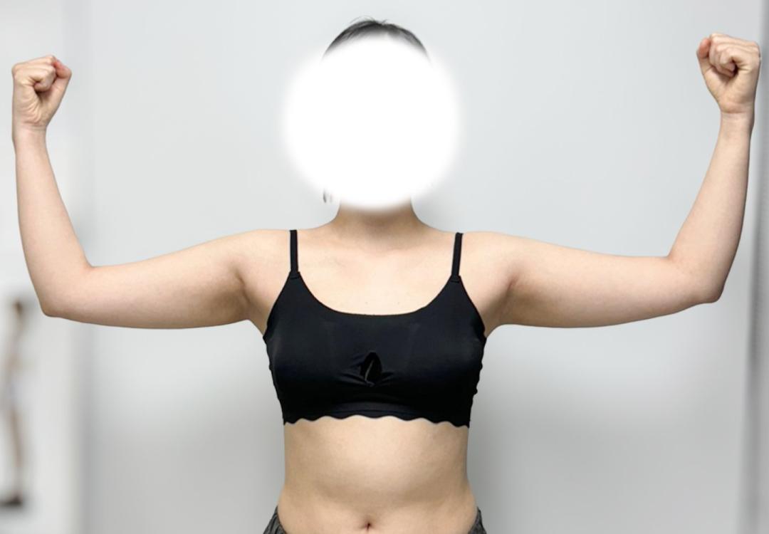 팔지방흡입 후기