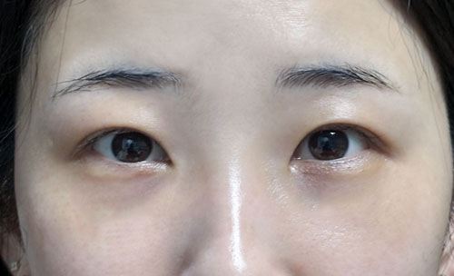 밑트임 후기