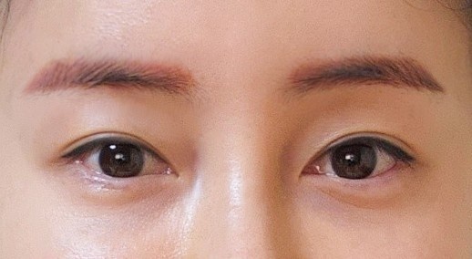 쌍꺼풀(매몰) 후기