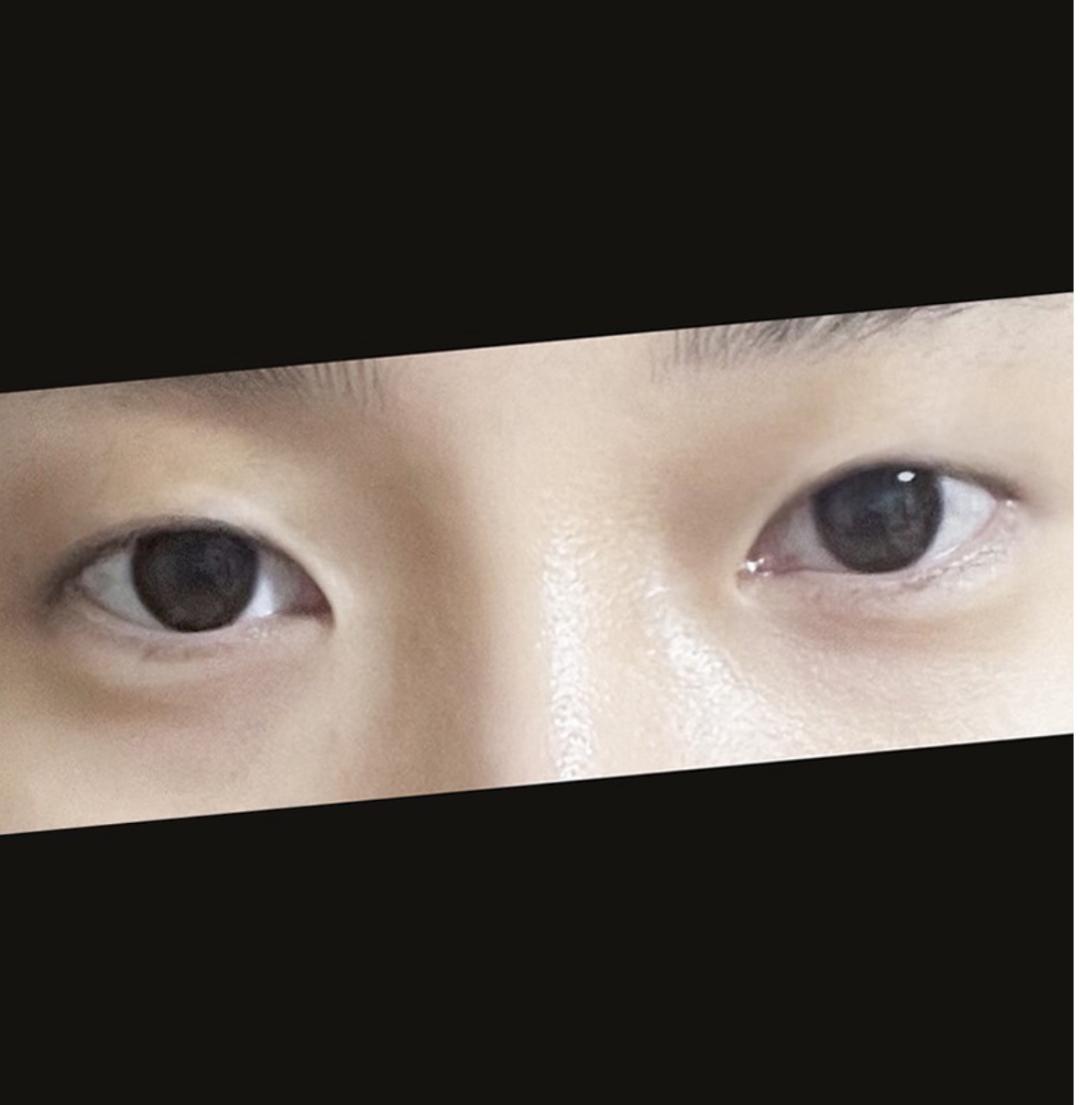밑트임 후기