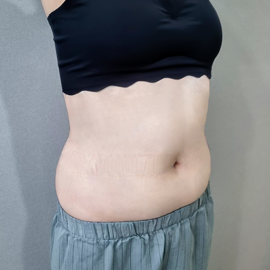 러브핸들지방흡입 후기