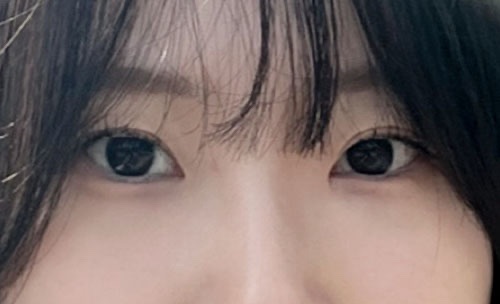 밑트임 후기