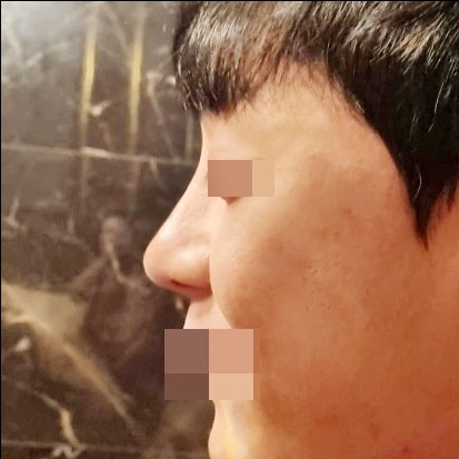 코끝(자가연골) 후기