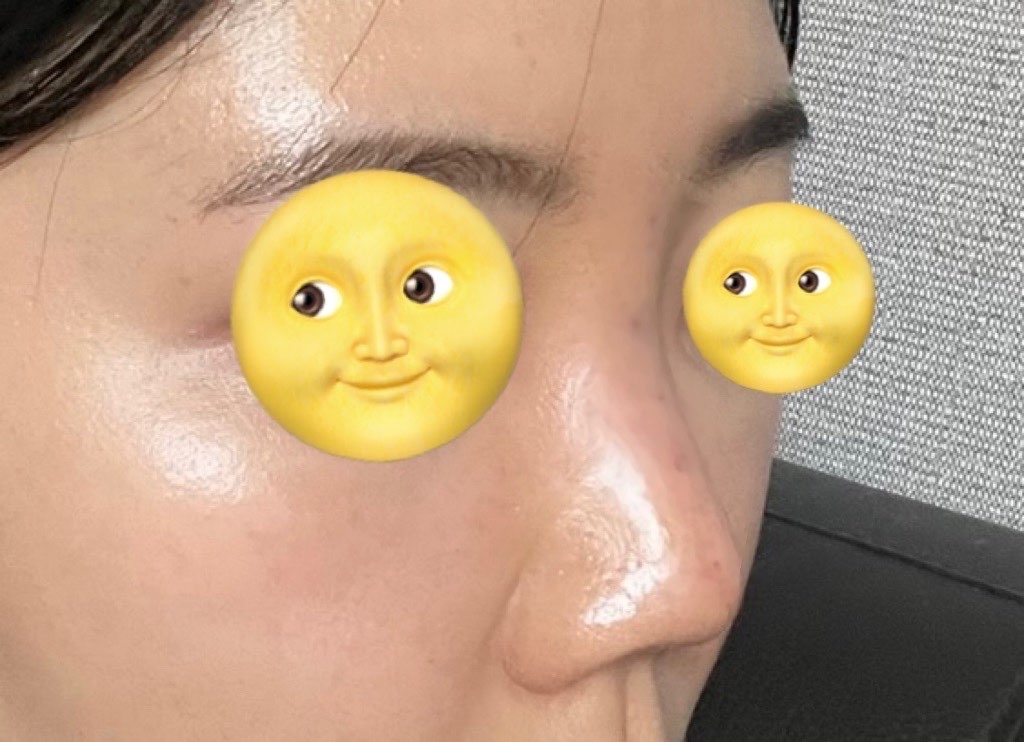 코끝(기증연골) 후기