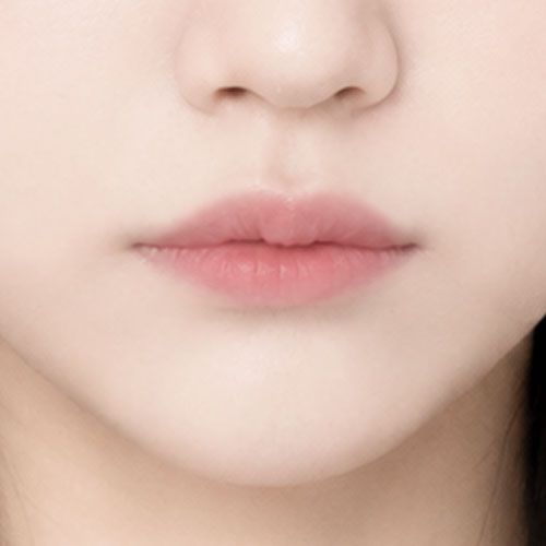 입꼬리성형 후기