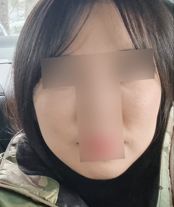 실리프팅 후기