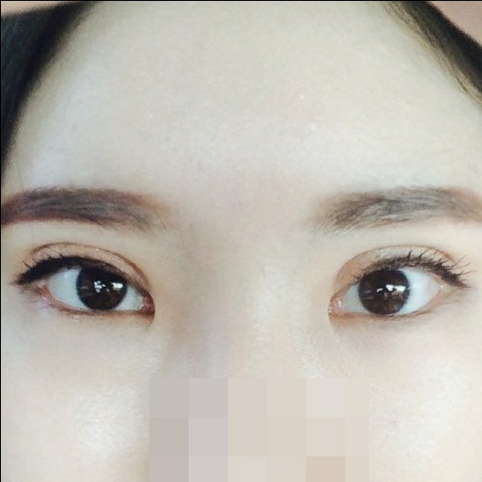 쌍꺼풀(절개) 후기