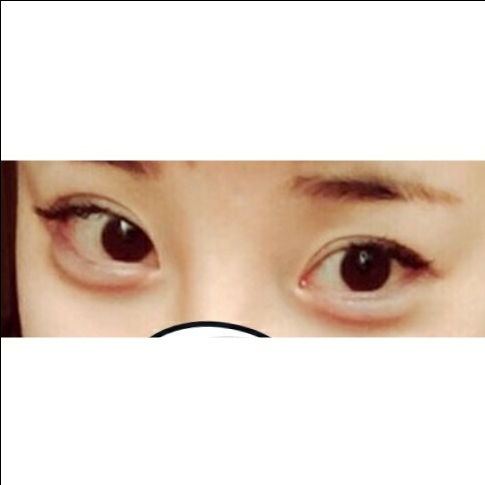 눈재수술 후기