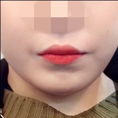 입꼬리성형 후기