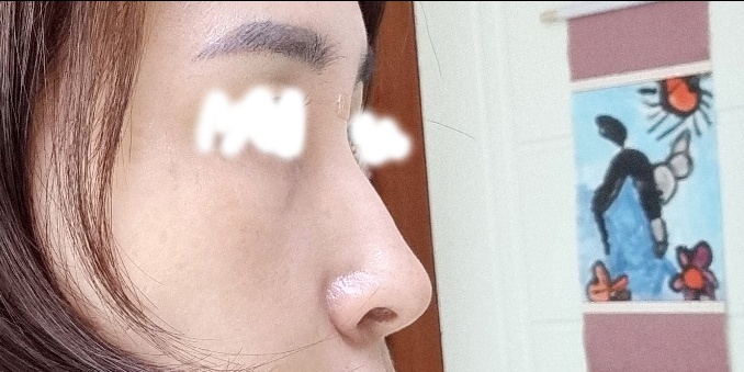 콧대(보형물) 후기