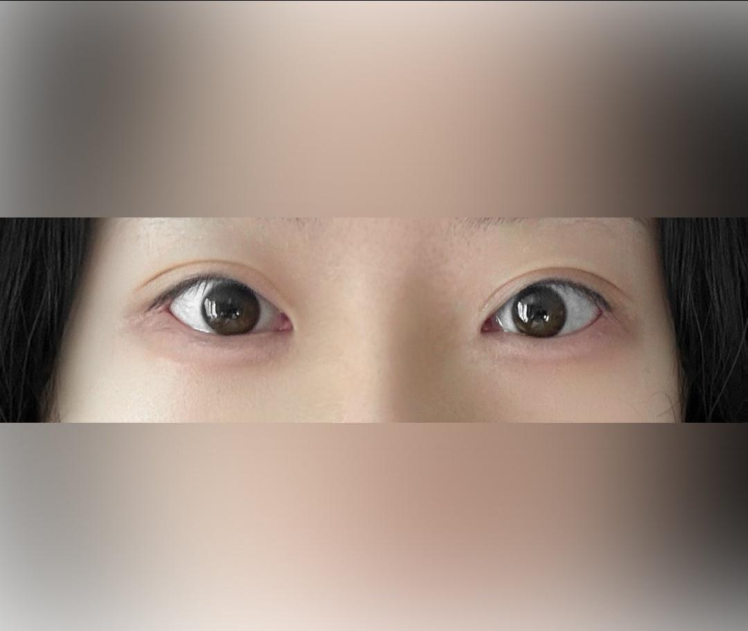 눈재수술 후기
