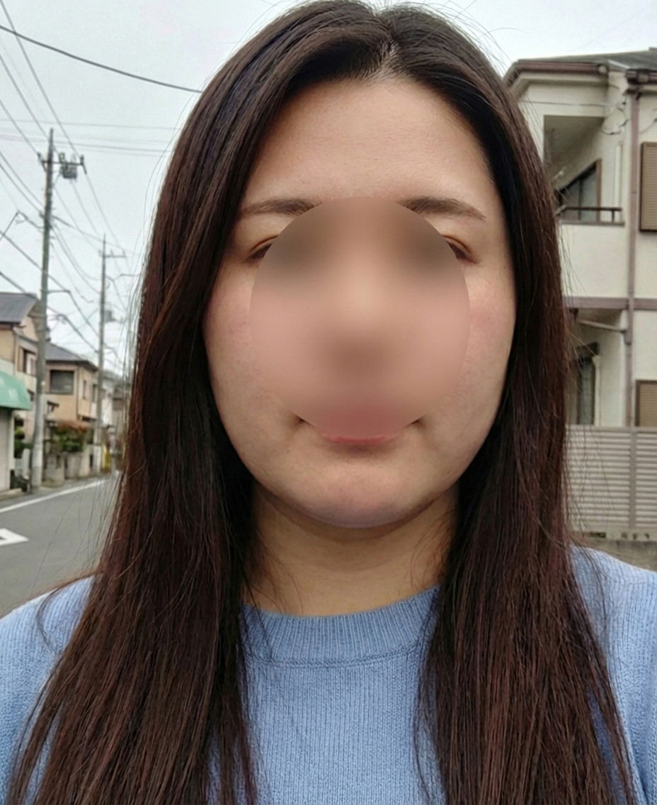 온다리프팅 후기