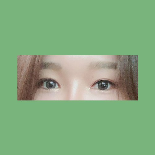 눈재수술 후기