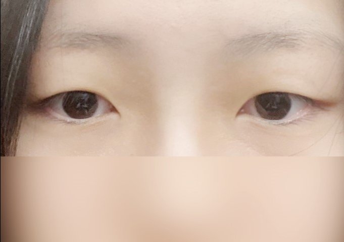 쌍꺼풀(절개) 후기