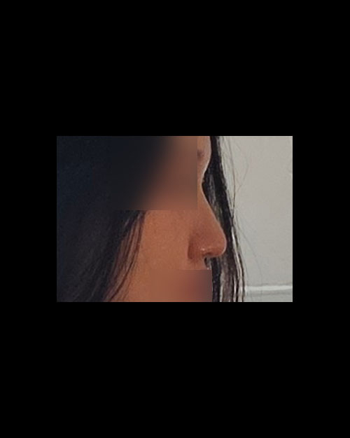 코재수술 후기