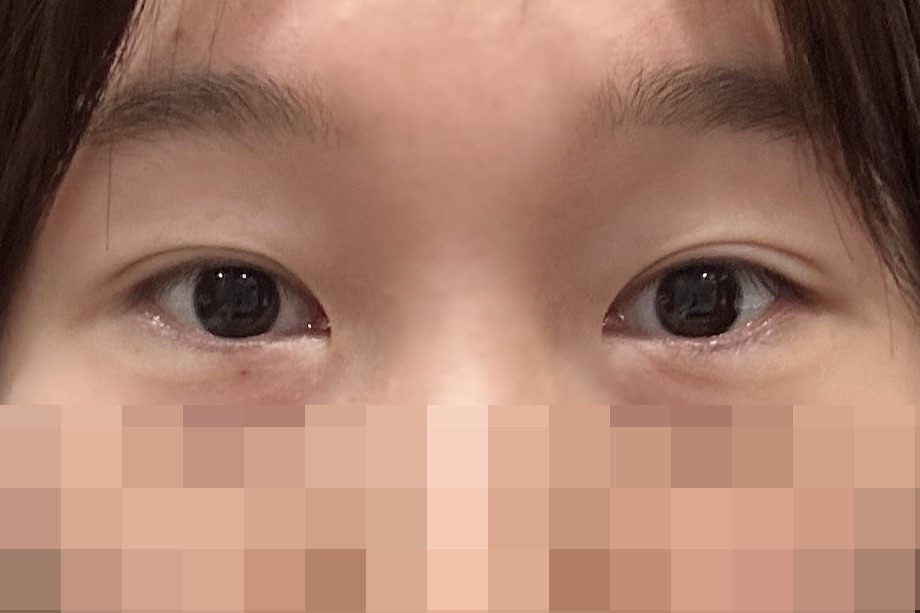 밑트임 후기