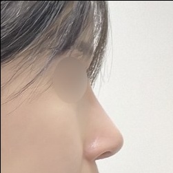 코재수술 후기