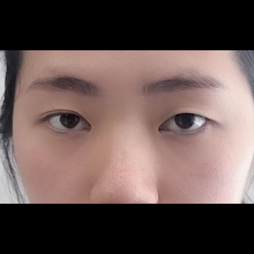 눈재수술 후기