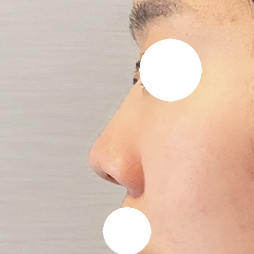 코끝(기증연골) 후기