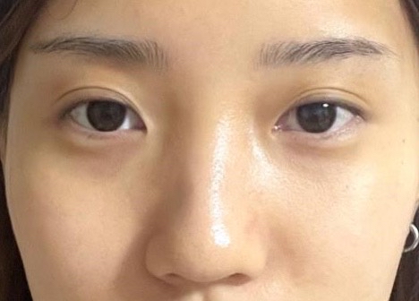 풀페이스지방이식 후기