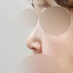 콧볼축소 후기