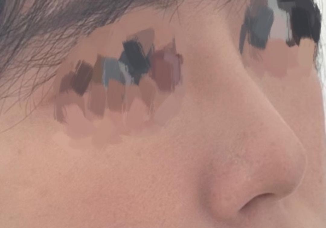 코끝(자가연골) 후기