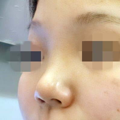 콧대(보형물) 후기