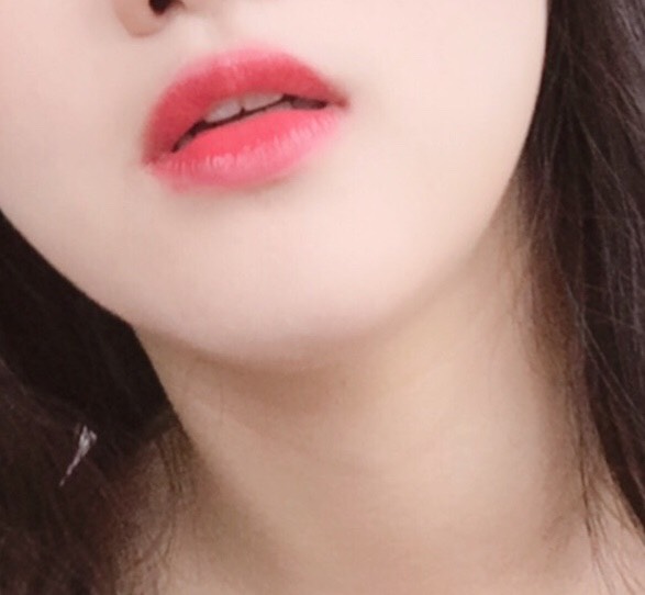 입꼬리성형 후기