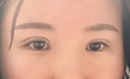 눈재수술 후기
