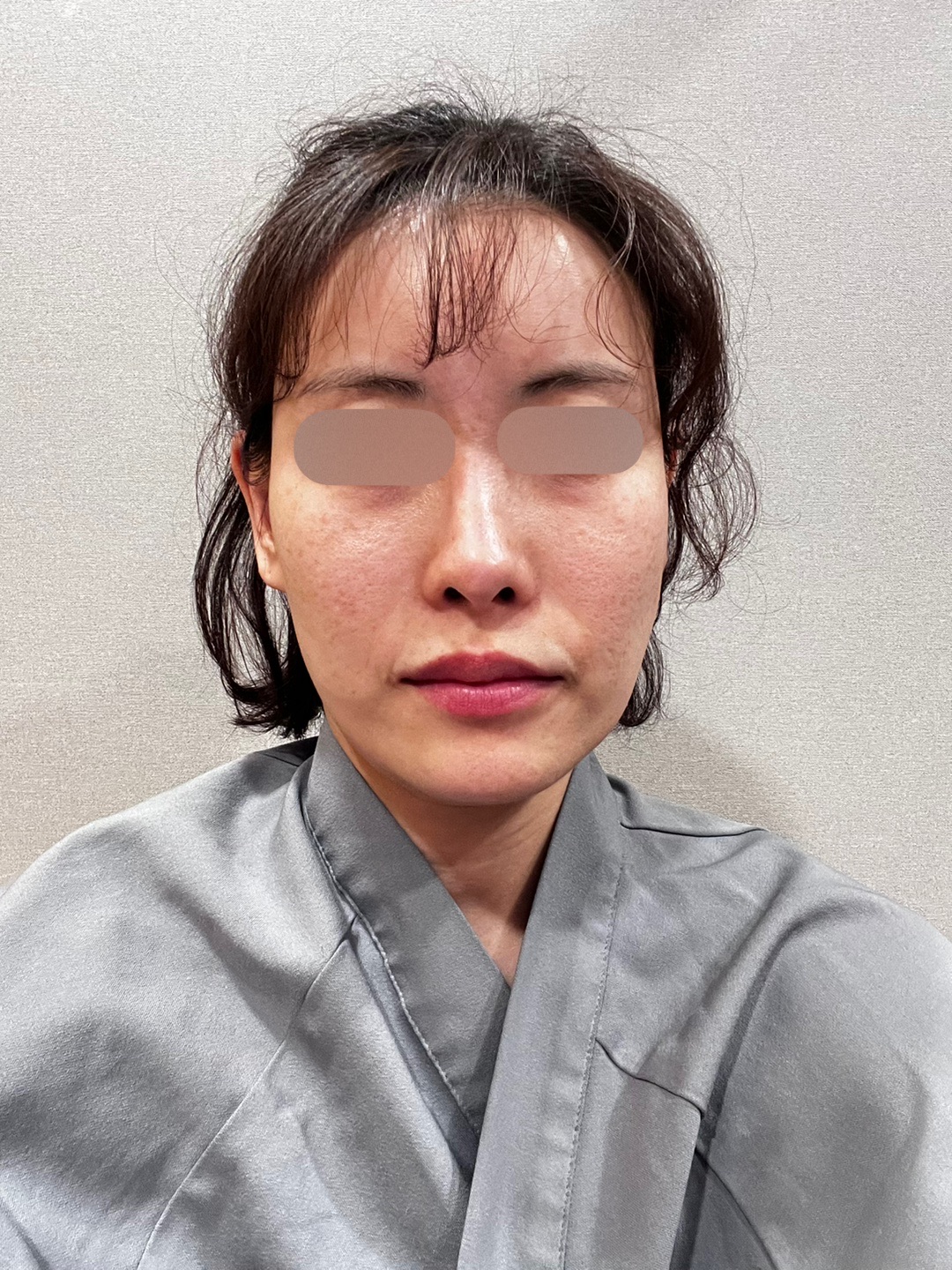 코재수술 후기