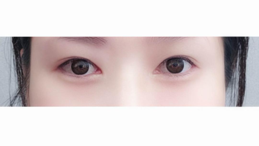 눈재수술 후기