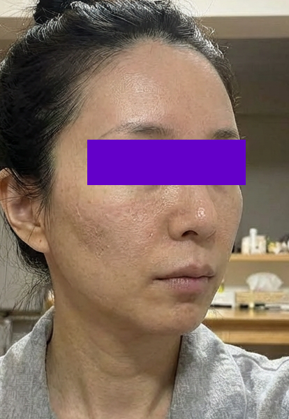리쥬란힐러 후기