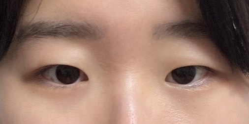 쌍꺼풀(절개) 후기