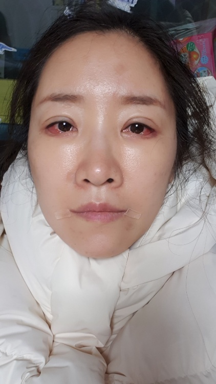 콧대(보형물) 후기