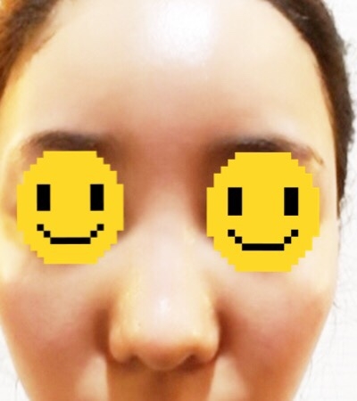 콧대(자가조직) 후기