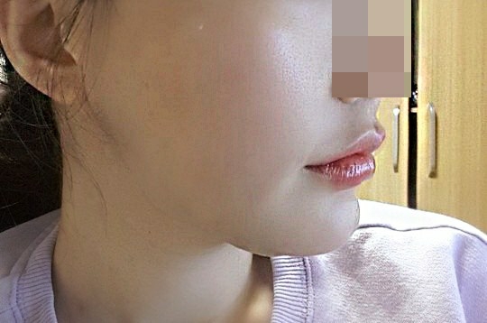 실리프팅 후기