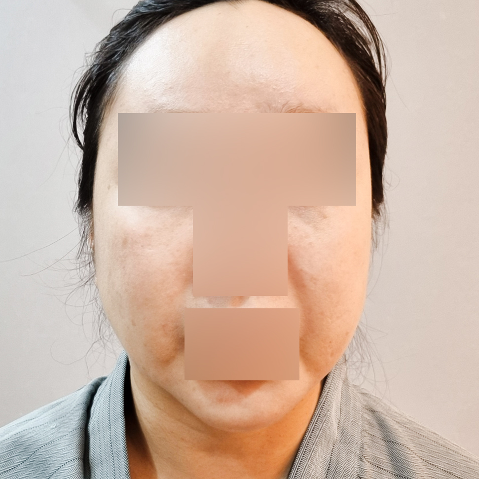 이중턱지방흡입 후기