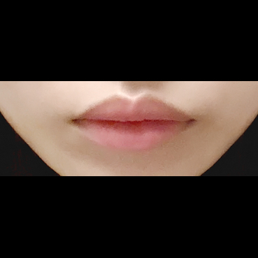 입꼬리성형 후기